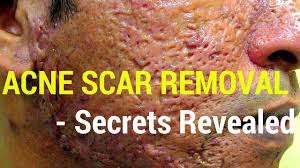 acne scar removal, reduction, and prevention